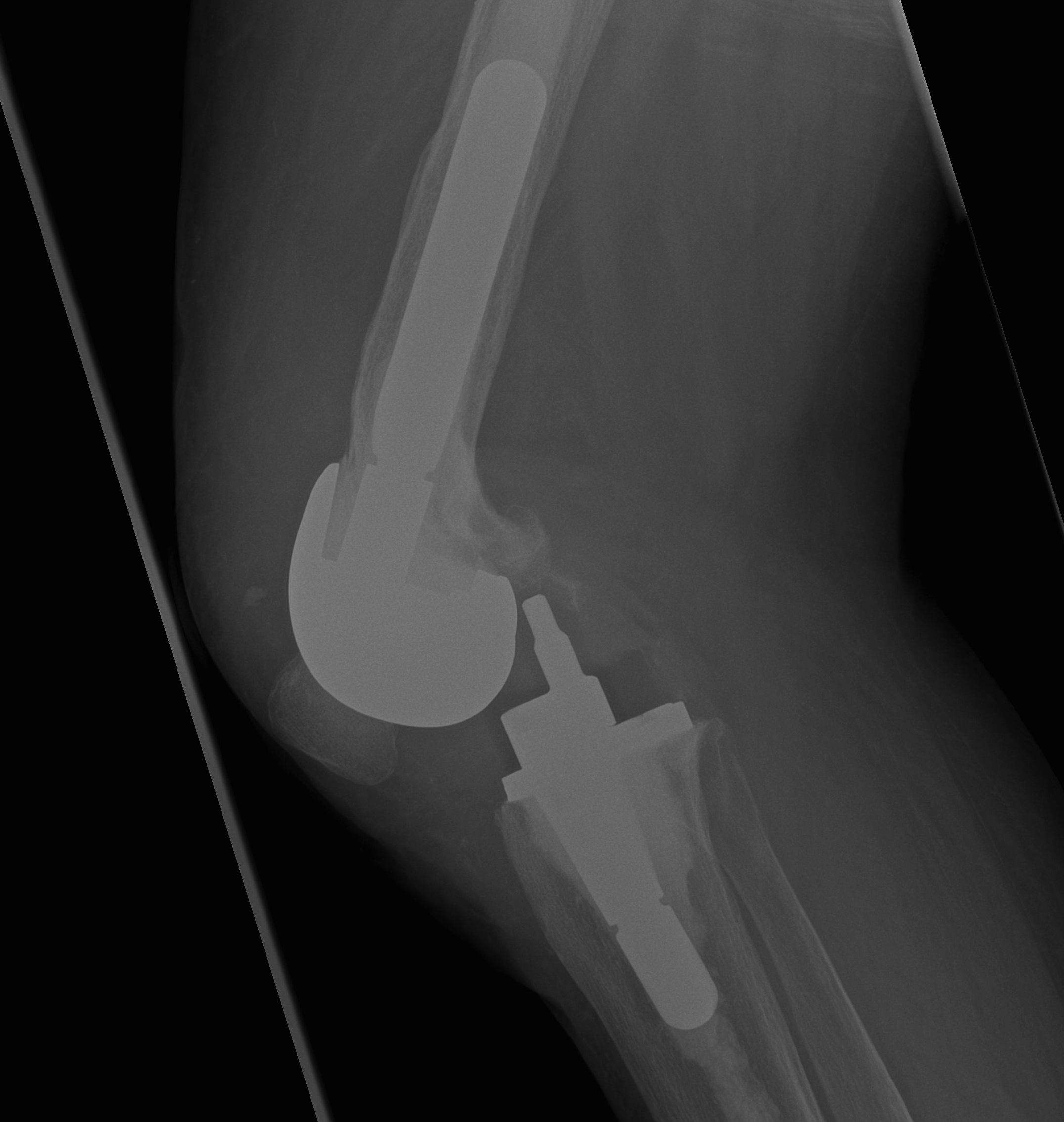 Revision TKR Dislocated HInge Lateral
